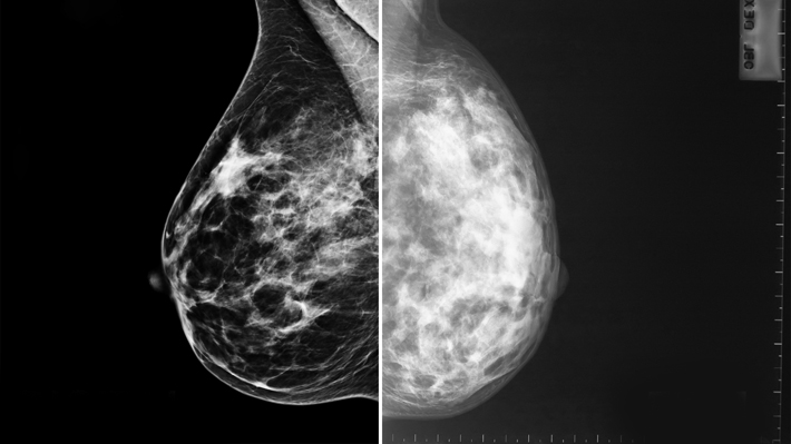 mammográfia